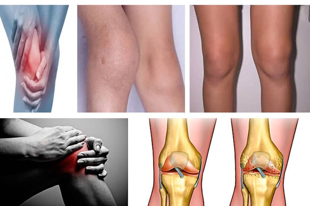Arthrosh co to jest